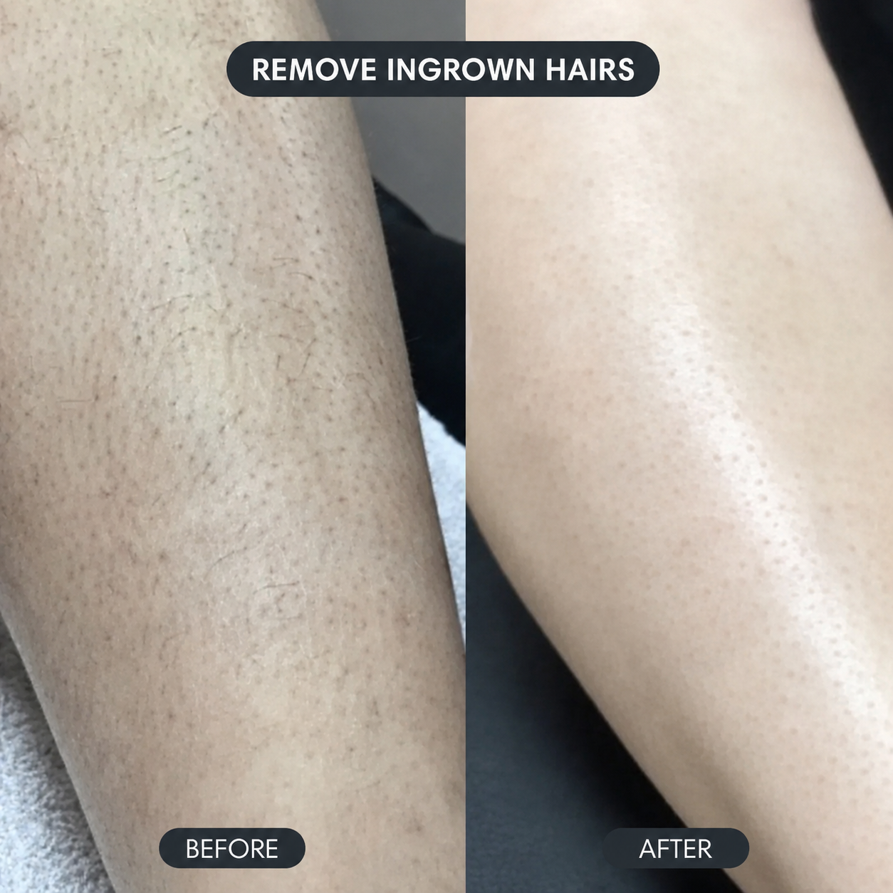 Solniera—Body Hair Removal Spray