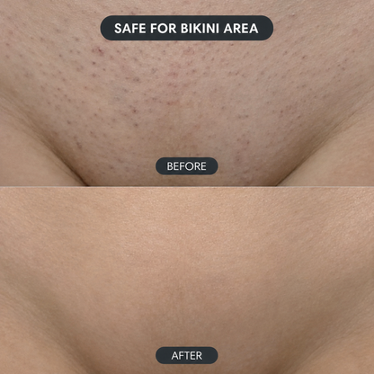 Solniera—Body Hair Removal Spray